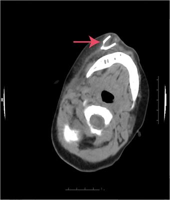 Case Report: A Case of a Child With Facial Foreign Body Abscess and Facial Artery Pseudoaneurysm